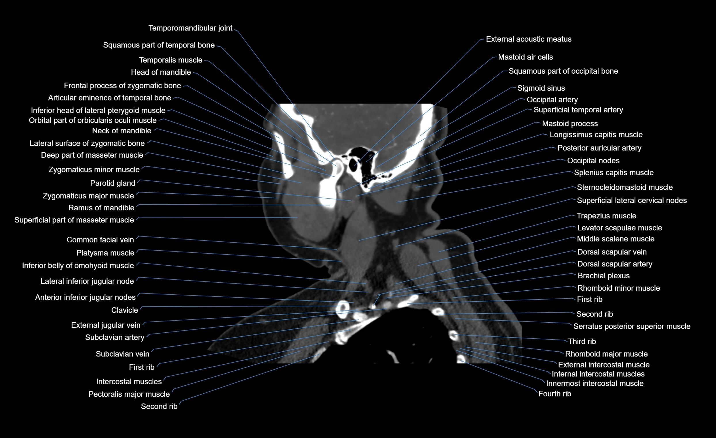 Neck CT sagittal cross sectional anatomy 3D  radiology  image-img-00001-00018.webp